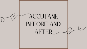 Acne journey and being on Accutane – Before and After
